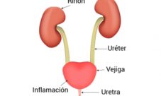 Razones por las cuales aparece una infección urinaria