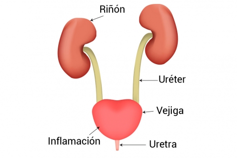 Razones por las cuales aparece una infección urinaria