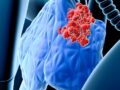 Qué es el cáncer linfático