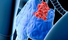 Qué es el cáncer linfático