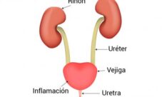 Remedios naturales para tratar o evitar una infección urinaria
