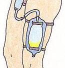 Sondas vesicales: Tipos, cuidados y complicaciones
