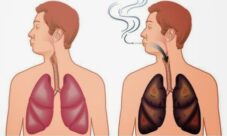 ¿Cómo afecta el tabaco al sistema respiratorio?