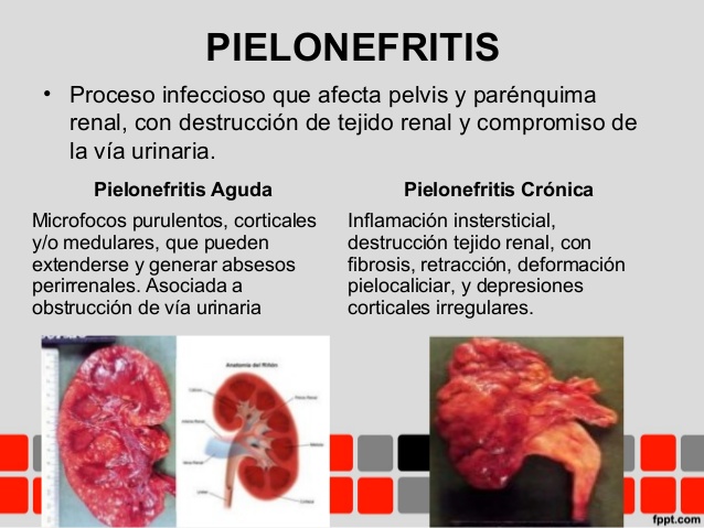 Pielonefritis. infección urinaria alta