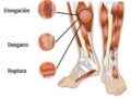 ¿Por qué se producen las lesiones musculares?